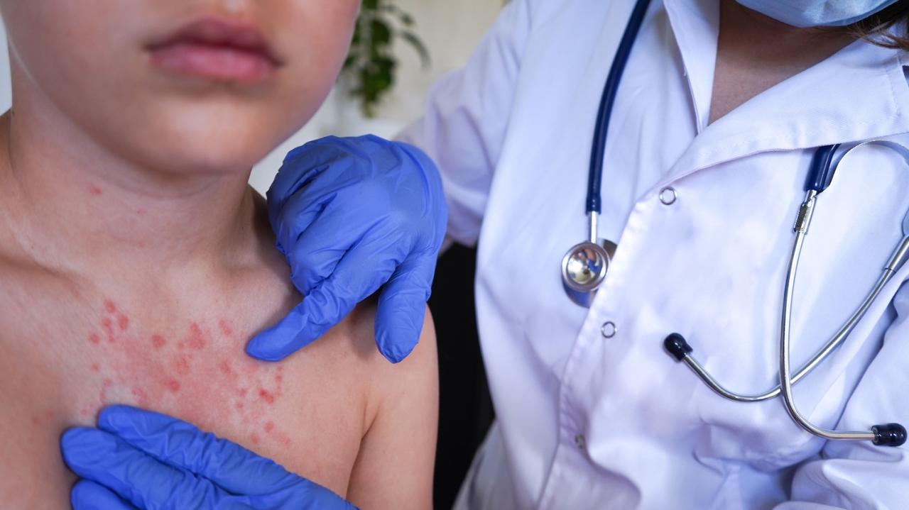 Scabies