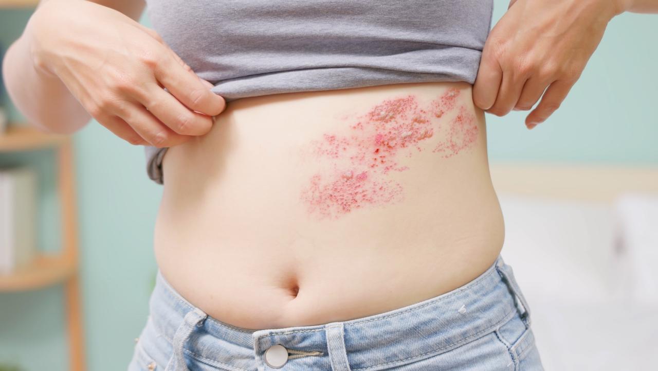 Shingles